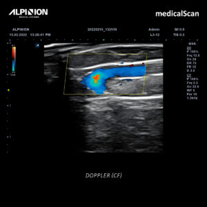 Ecografía con Doppler (CF)