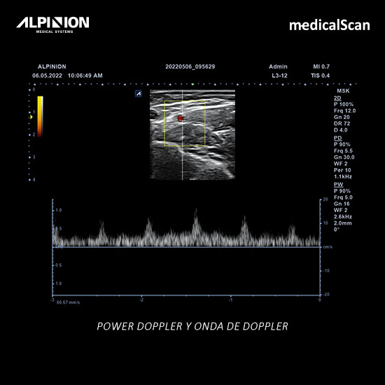 Ecografía power doppler y onda de doppler 